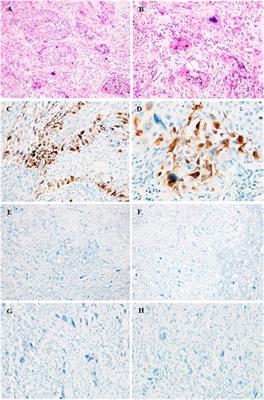 Case report: Urothelial carcinoma of the renal pelvis with trophoblastic differentiation: A rare case report and review of literature